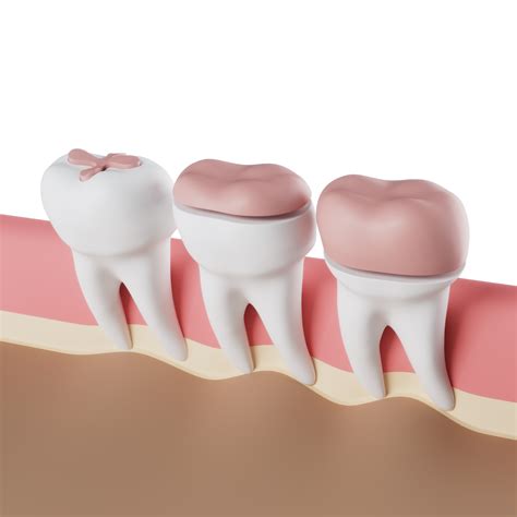 Dental Inlays & Onlays - Materials, Procedure & Costs