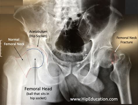 Femoral Neck Fracture - HipEducation