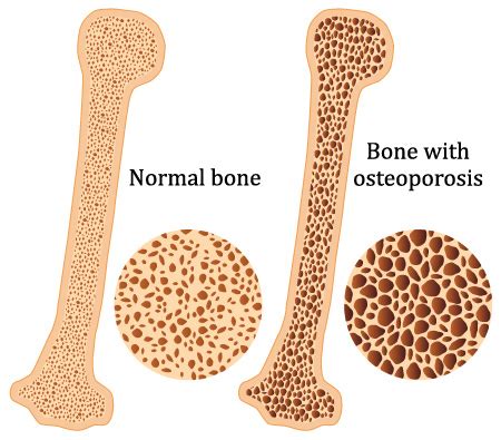 Osteoporosis | Obstetrics & Gynecology of Atlanta