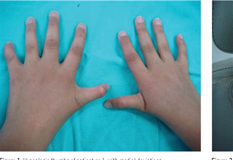 Figure 1 from Oral and Dental Manifestations of Diamond-Blackfan Anemia ...