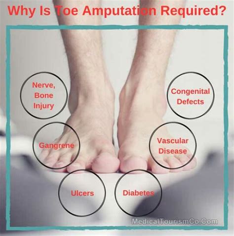 Toe Amputation Surgery Abroad