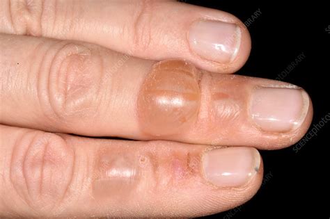 Blisters following burn injury - Stock Image - C038/1708 - Science ...