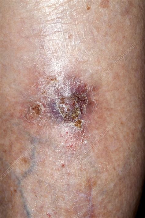 Wound after skin cancer removal - Stock Image - C014/2811 - Science ...