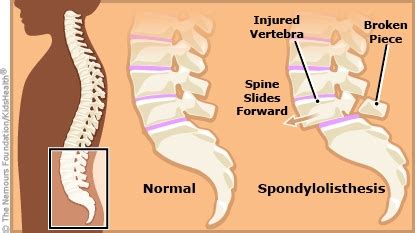 Spondylolisthesis | Rady Children's Hospital