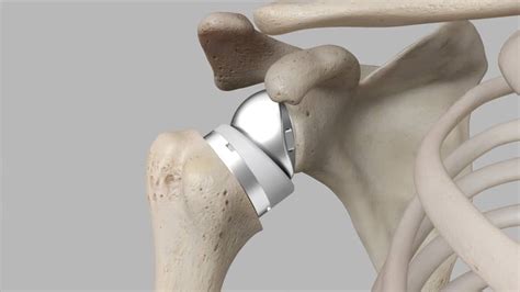 Video: Reverse Shoulder Replacement Patient Animation | www.exac.com