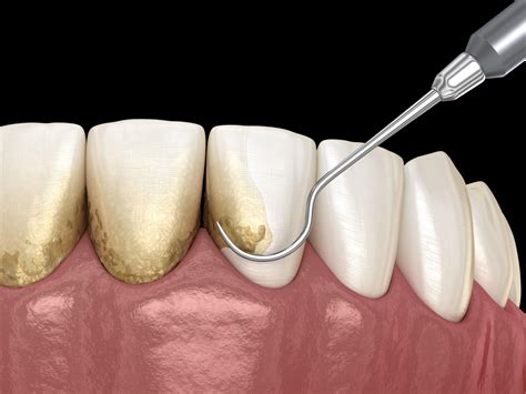 How to Remove Tartar Buildup from Teeth without dentist helps