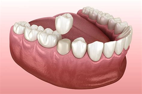 Does a Dental Crown Help After a Root Canal?