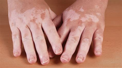 Skin Discolouration: Causes, Remedies, and More - HealthKart