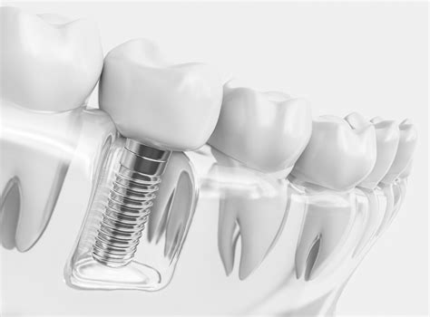 The Pros And Cons Of Dental Implants & Dental Crowns