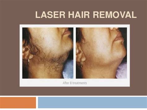 Pain free laser hair removal in delhi