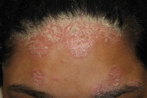 Head And Shoulders Rash On Face Hotsell | aria-database.com