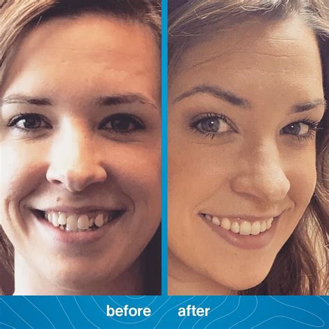 Invisalign Before and After PhotosDr. Jacquie Monroe Ortho