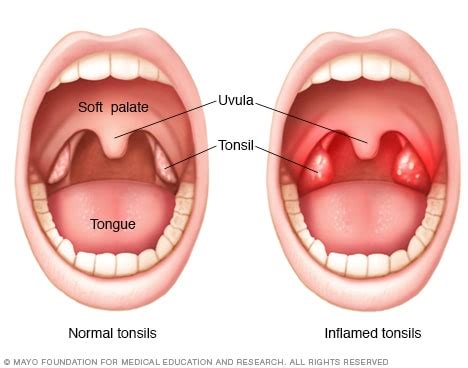 How To Reduce The Swelling Of Tonsils - Respectprint22