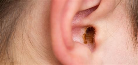 Wax off! Tackling earwax blockage head-on | Happiest Health