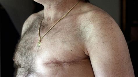 Double mastectomies for men with breast cancer on rise - CNN