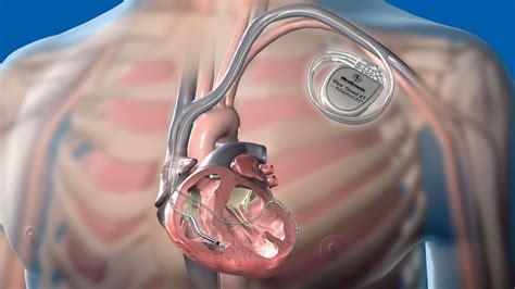 Un fallo permite a hackers tomar el control de implantes cardiacos