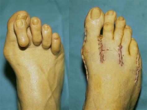 Hammer toes before and after surgery - MEDizzy