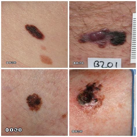 Melanoma Skin Cancer Symptoms