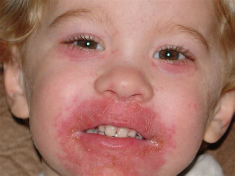 perioral dermatitis - DrBeckmann