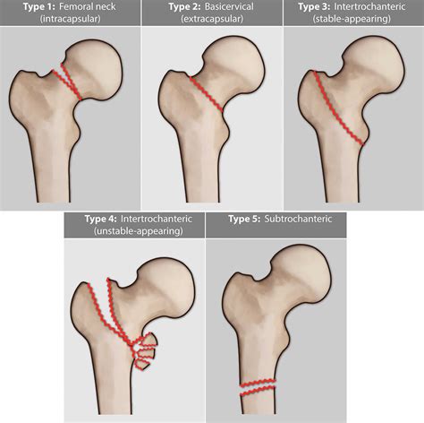 Femoral neck fracture causes, types, symptoms, diagnosis, treatment ...