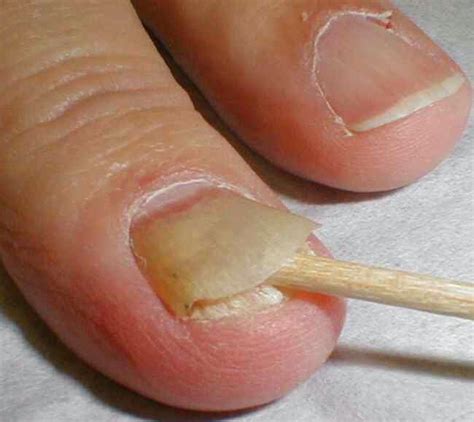 What Causes Fungal Nail Infection and How Can It Be Addressed? : Nail ...