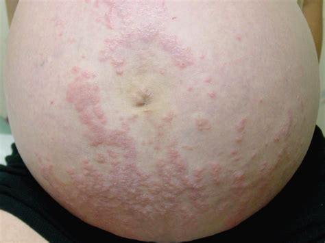 Pruritic Urticarial Papules And Plaques Of Pregnancy First Trimester