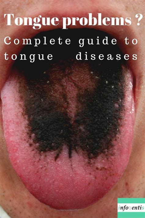 15 of the most common tongue diseases that can affect you