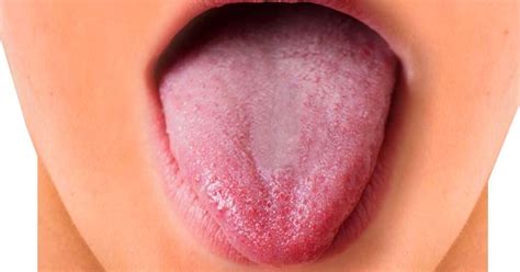 Have Painful Tongue Bumps? Plano's #1 dentist Haight Family Dentistry