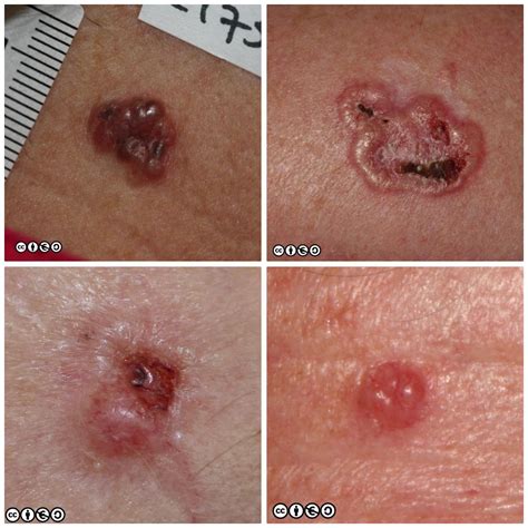 Basal Cell Carcinoma Late Stages – NBKomputer