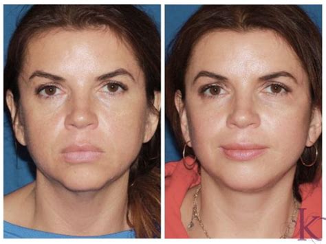 Mini Facelift Before and After Photo Gallery | NYC New York, NY ...