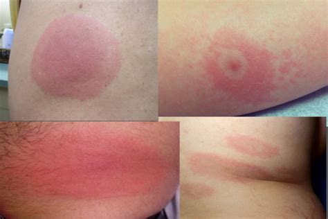 What does a Lyme disease rash look like? - Daniel Cameron, MD, MPH