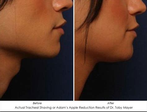 Adam's Apple Reduction For Female Patients - AHB