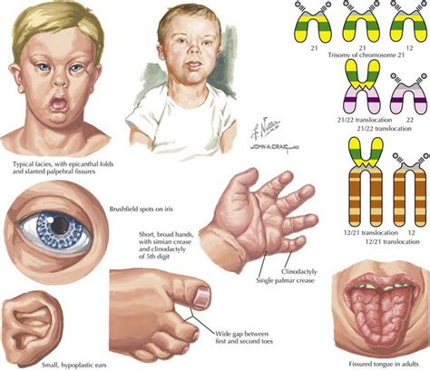 Phenotype Of Down Syndrome - Captions Hunter