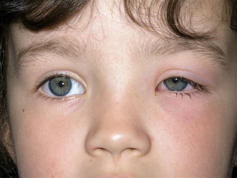 Periorbital (preseptal) cellulitis: Swelling under one eye | BabyCenter