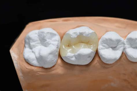 Dental Inlays Vs. Onlays: Do You Need Them? (Pros & Cons)