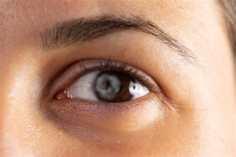 Coloboma: Symptoms, Diagnosis and Treatment - accuspire