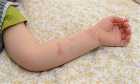 First Aid for Burns in Children | Kids Clinic Singapore