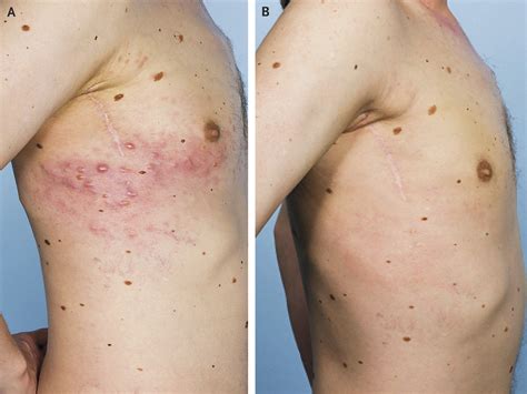 Zosteriform Metastases from Malignant Melanoma — NEJM