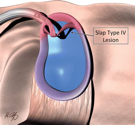 Glenoid Labrum Anatomy