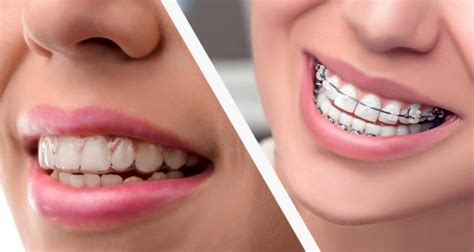 Can You Get Invisalign After Braces? | Stanley Dentistry