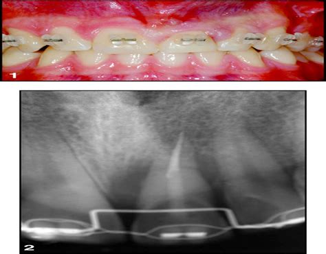 Implant Rehabilitation of Central Incisor: A Staged Approach : Implant ...