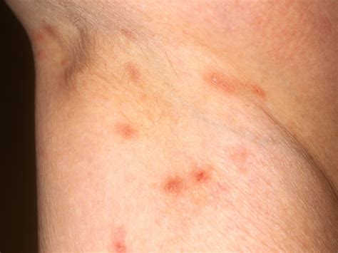 Rashes That Look Like Scabies: Causes, Symptoms, And Treatment ...