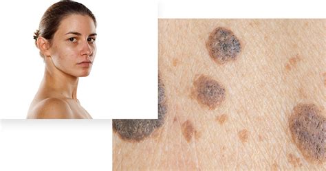 Brown Spots on the Skin | Advanced Dermatology, P.C.