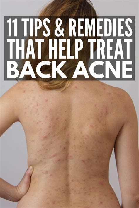 Cystic Acne Treatment, Back Acne Treatment, Natural Acne Treatment ...