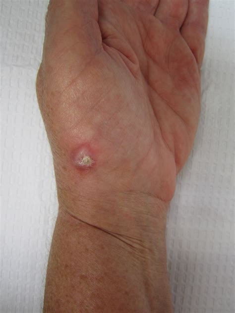 Lumps, Bumps, and Cysts in the Hand - John Erickson, MD