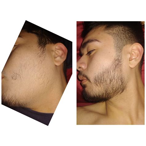 Rogaine For Beard Before And After Generally rogaine is not a good idea ...