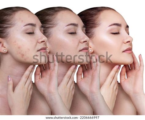 Young Woman Before After Acne Treatment Stock Photo 2206666997 ...