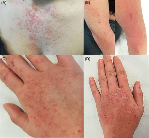 Polymorphous eruption with macules, papules, wheals, vesicles, crusts ...