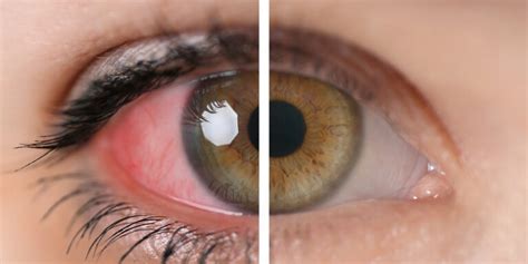 Uveitis: Causes, Symptoms And Available Treatment Methods