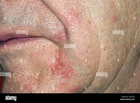 Close-up of a shingles rash on the face in a 77 year old male patient ...